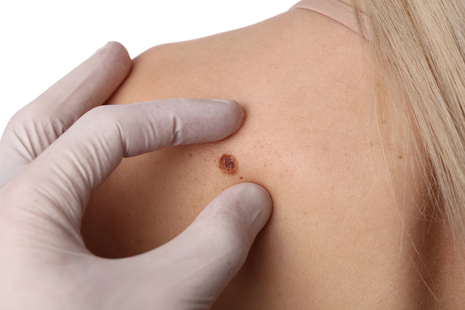 Western-District-Skin-Cancer-Service-mole-on-skin-2