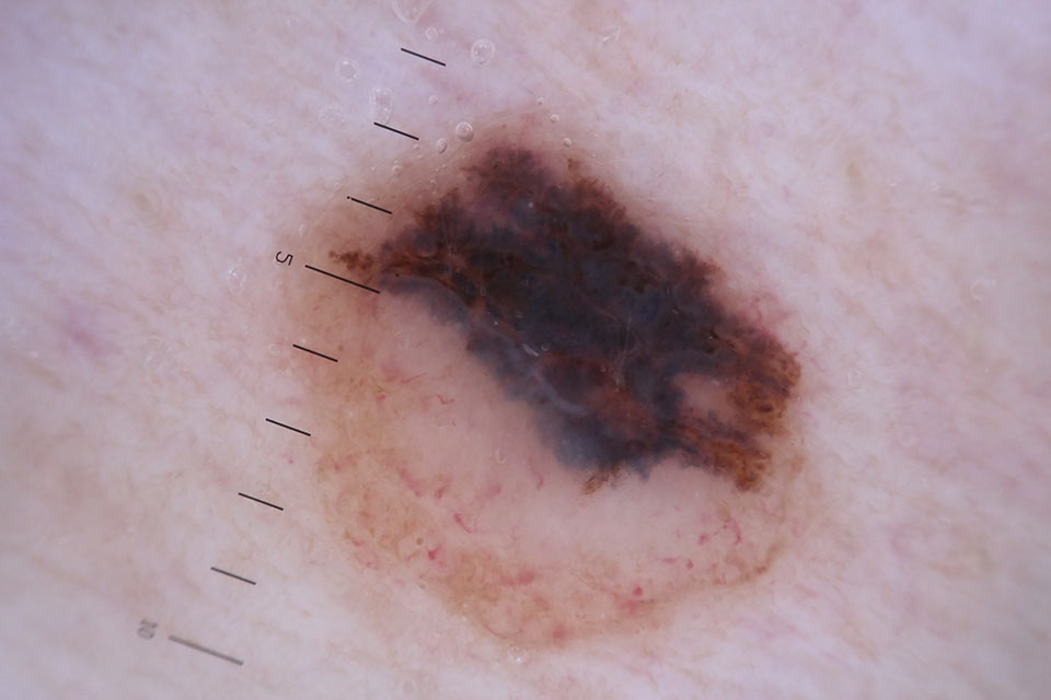 Western-District-Skin-Cancer-Service-moles-close-up